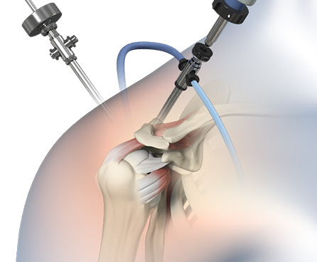 Advanced Arthroscopic Techniques