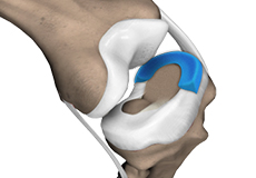 Meniscal Transplantation