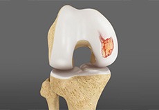 Articular Cartilage Injury