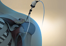 Benefits of Arthroscopic Surgery
