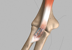 Elbow Tendon and Ligament Repair