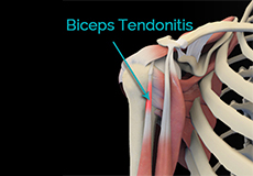 Bicep Tendon Rupture