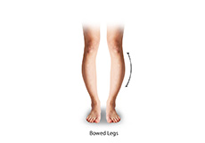 Bowed Legs