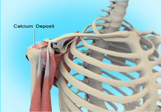 Calcification Tendinitis