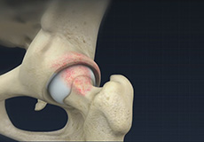 Femoral Osteoplasty