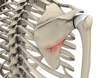 Fracture of the Shoulder Blade (Scapula)