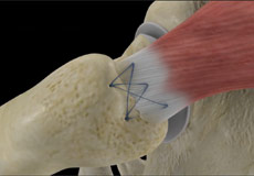 Gluteus Tendon Tear