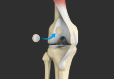 Ligament Preservation/Repair