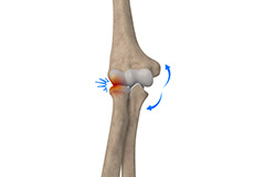 Lateral Impingement of the Elbow