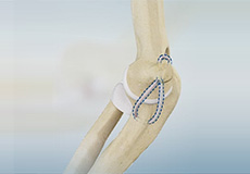 Ligament Reconstruction