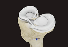 Meniscus Replacement