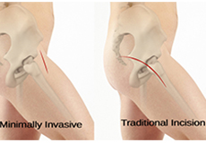 Minimally Invasive Hip Replacement