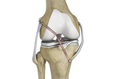 Knee Ligament Reconstruction