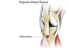 Osgood-Schlatter Disease