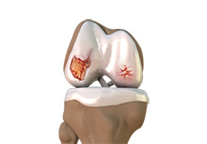 Osteoarthritis Management