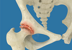 Osteoarthritis