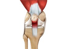 Patellar Tendinitis