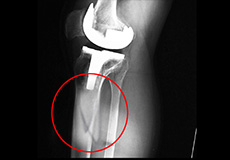 Periprosthetic Knee Fractures