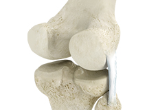 Posterolateral Corner Reconstruction