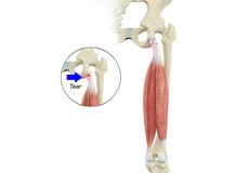 Proximal Hamstring Repair