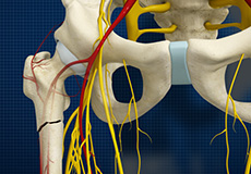 Subtrochanteric Hip Fracture