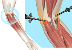 Tennis Elbow Surgery