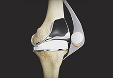 Tricompartmental Knee Replacement